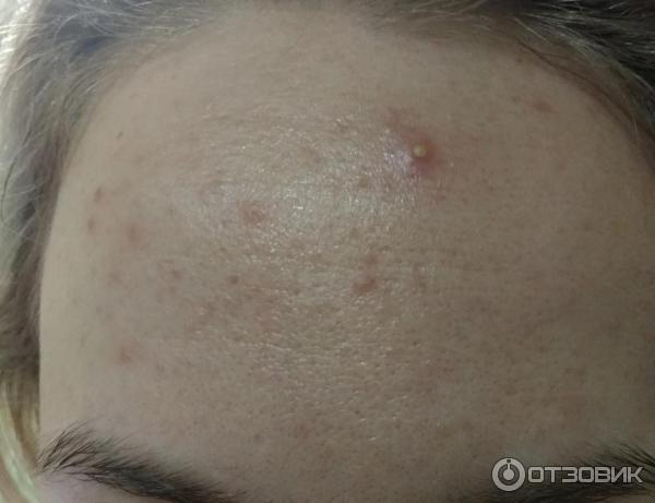 Отзыв о Гель для наружного применения 15% Озон "Скиноклир" | Наконец-то ...