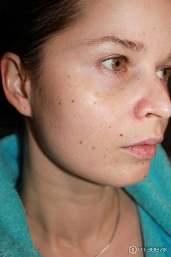 может ли быть аллергия на гиалуроновой. может ли быть аллергия на гиалуроновой. аллергия на филлер гиалуроновой кислоты. гиалуроновый крем до и после.