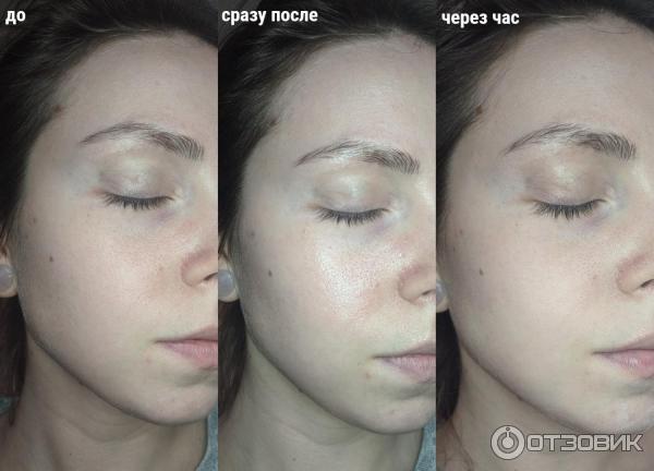 тиогамма для лица от морщин. картинки до и после пилинга. тиогамма для лица до и после. тиогамма в косметологии до и после применения для лица. до пилинга после фото лицо.