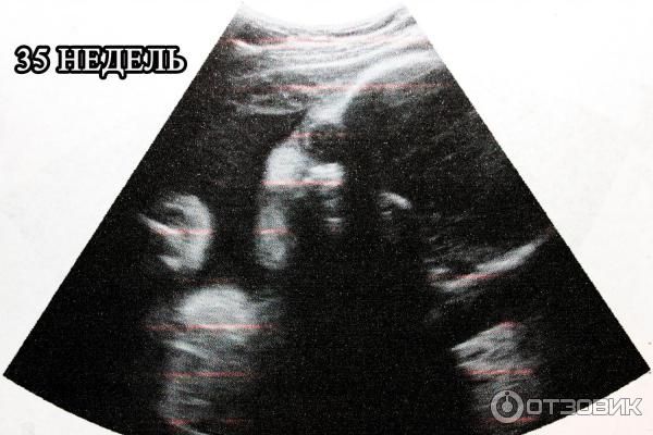 Отзыв о УЗИ во время беременности | И успокаивающая, и информативная, и ...