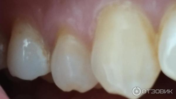 Ультразвуковой скалер для чистки зубов Dental Tools фото