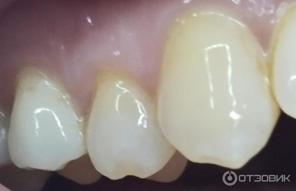 Ультразвуковой скалер для чистки зубов Dental Tools фото